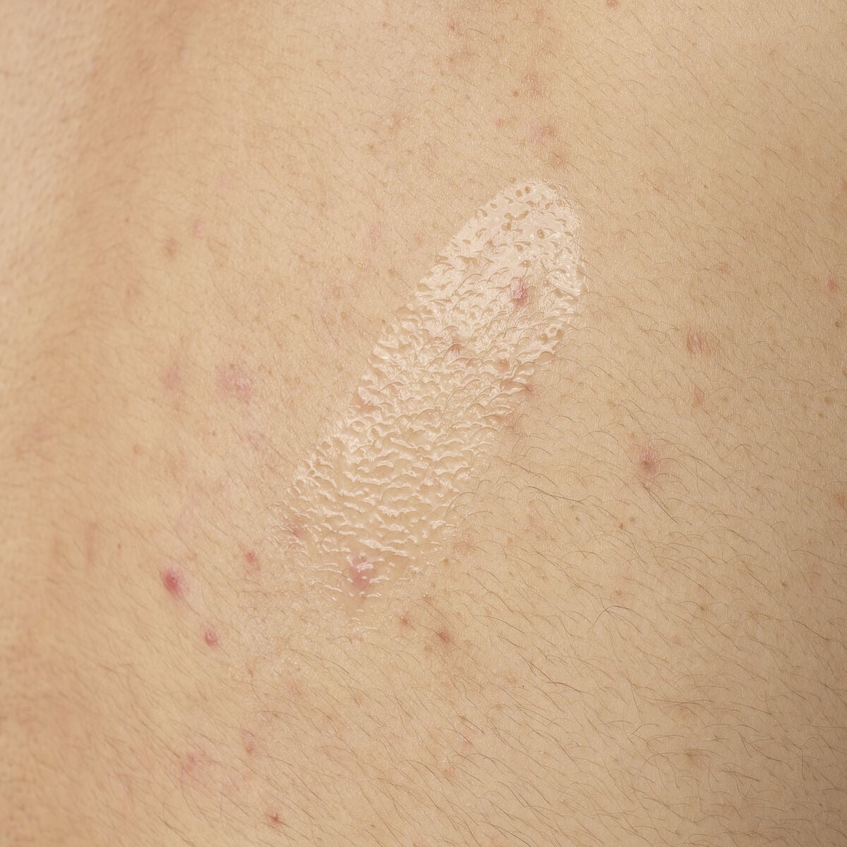 salicylic-acid-0-5-body-serum-r6 ORD-salicylic-acid-05-body-240ml-application.jpg