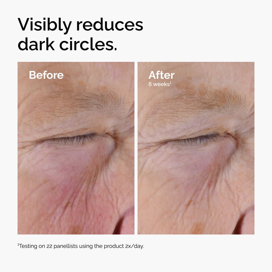 caffeine-solution-5-egcg-eye-serum-d8 ord-caffeine-solution-egcg-dark-circles-before-after.jpg