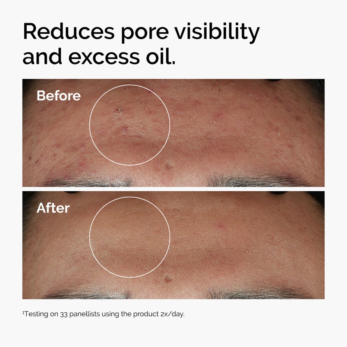 niacinamide-10-zinc-1-w9 ord-niacinamide-zinc-blemish-serum-before-after-pores.jpg