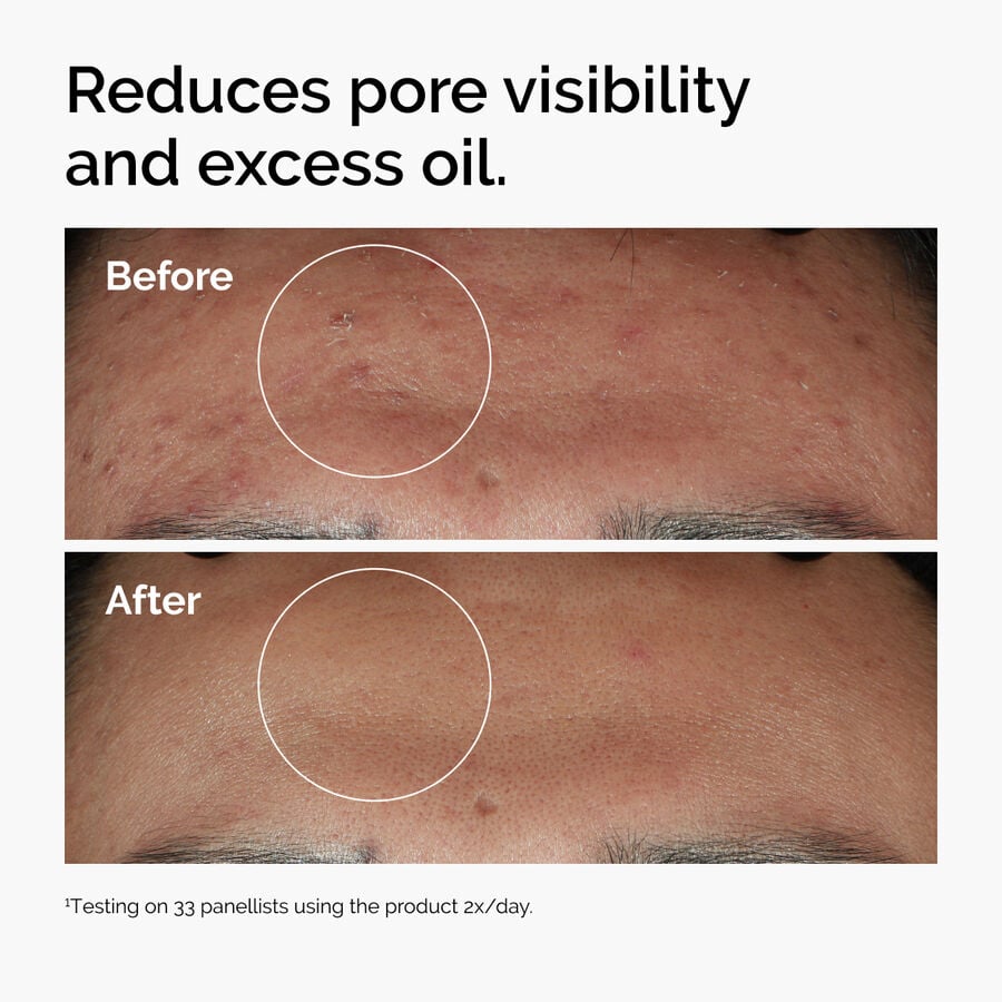 niacinamide-10-zinc-1-w9 ord-niacinamide-zinc-blemish-serum-before-after-pores.jpg