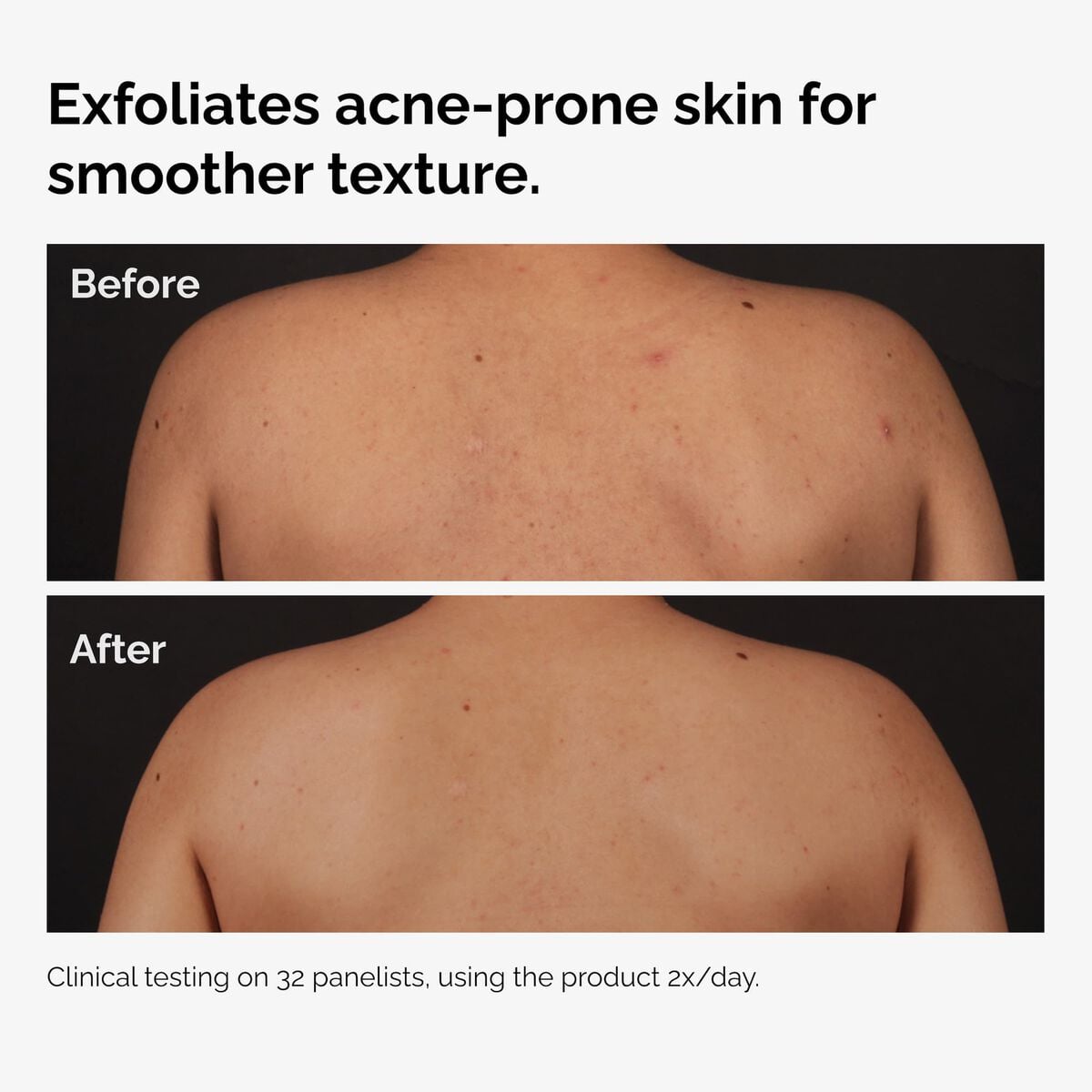 salicylic-acid-0-5-body-serum-r6 ord-salicylic-acid-body-serum-before-after-graphic-NA.jpg