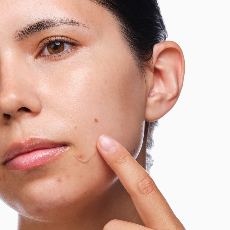 the-acne-set-d0 rdn-the-acne-set-application.png